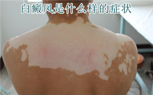 颈部白癜风的护理怎么做